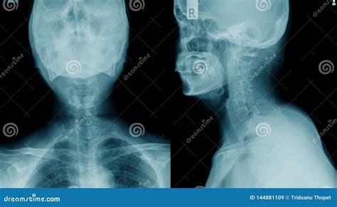 X-ray C-spine, Case Cervical Spondylosis Stock Image - Image of medicine, anatomy: 144881109