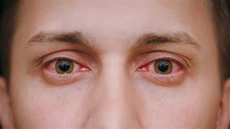 ¿Cuáles son las causas de los ojos rojos? - N Digital