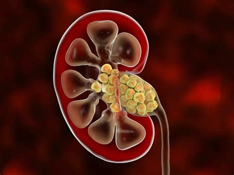 Kidney Stone: Symptoms, 6 Causes, And Possible Treatments - fmwhat