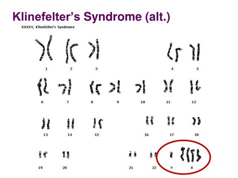 PPT - Chromosomal Abnormalities in Humans PowerPoint Presentation, free download - ID:2171559