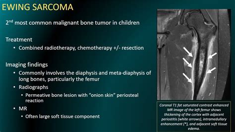 Ewing Sarcoma X Ray