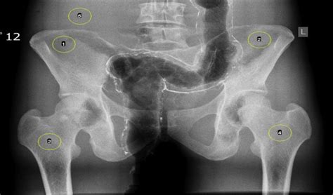 Can the anode heel effect be used to optimise radiation dose and image quality for AP pelvis ...