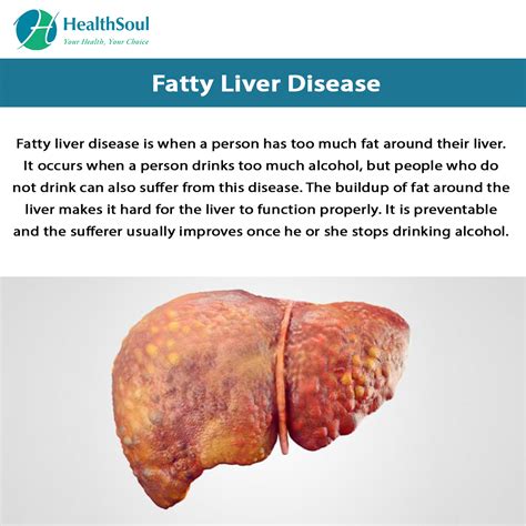 What Is Fatty Liver Disease