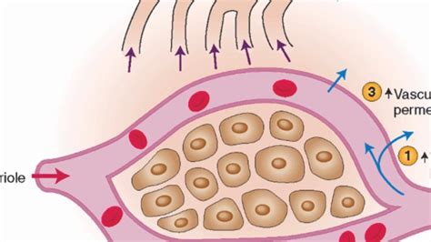 Mechanisms of edema development - YouTube