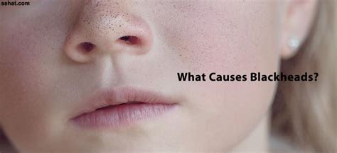 What Causes Blackheads? | How to Treat Blackheads | Sehat