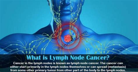 Cancer%2BSpread%2Bto%2BLymph%2BNodes%2BLife%2BExpectancy.jpg