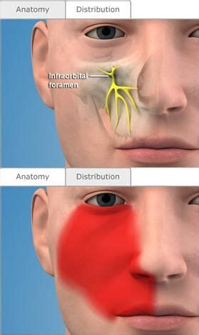 INFRA ORBITAL NERVE BLOCK | Dental hygiene school, Registered dental hygienist, Implant dentistry