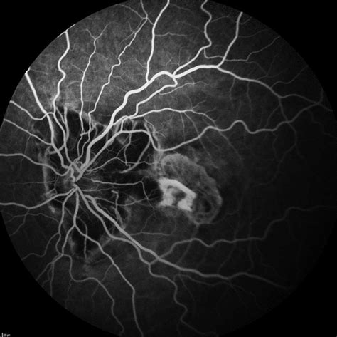 Fluorescein angiography of the left eye 4 years after first... | Download Scientific Diagram