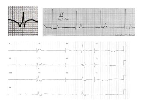 ECG Lecture: Sinus arrest, sinoatrial exit block, AV block and escape rhythms