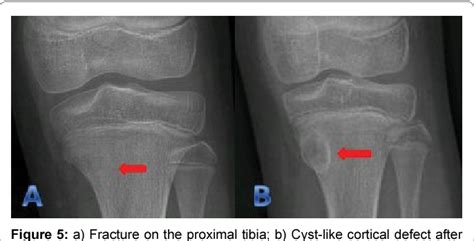 [PDF] Cyst-Like Cortical Defects Following Fractures in Children: Series of 5 Cases | Semantic ...