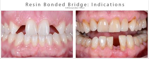 Resin Bonded Bridge: Minimally Invasive Option for Tooth Replacement - Shor Dental