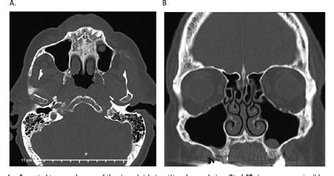 Figure 1 from A case study of phantosmia cured by antibiotic treatment ...