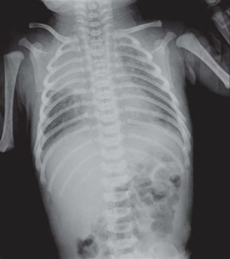 Study Medical Photos: Meconium Aspiration Syndrome - X ray Chest