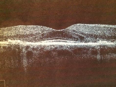 Plaquenil Retinopathy Screening Requirements: Are You Up to Date on the New Standards? - Eyedolatry