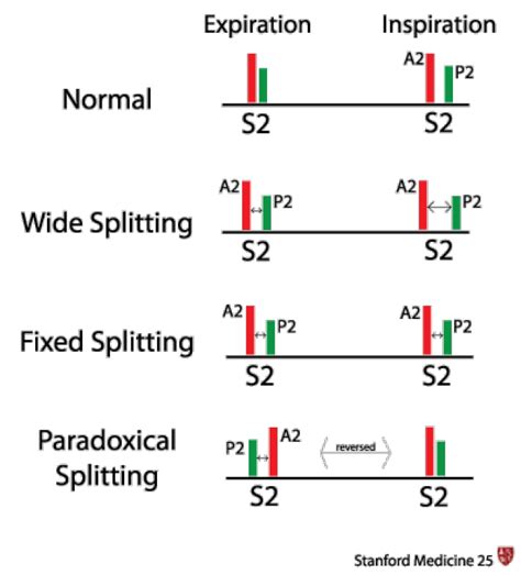 Cardiac Second Sounds | Stanford Medicine 25 | Stanford Medicine