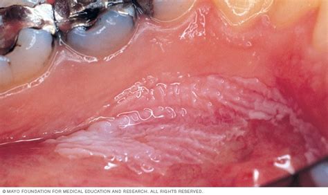 Leukoplakia Disease Reference Guide - Drugs.com