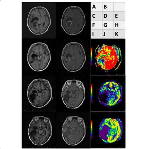 Brain magnetic resonance imaging (MRI) results for glioblastoma ...