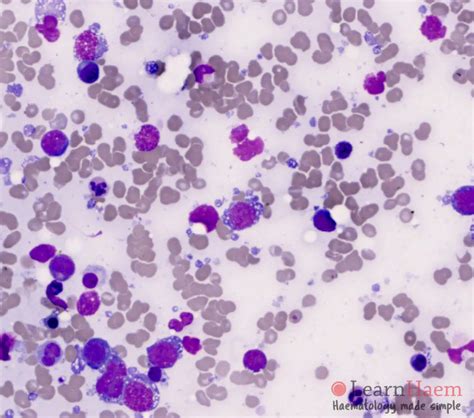 Diffuse Large B Cell Lymphoma - LearnHaem | Haematology Made Simple