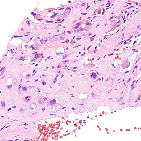 Epithelioid hemangioendothelioma - Libre Pathology