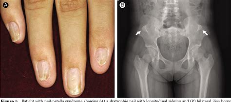 Figure 2 from A Synonymous Genetic Alteration of LMX1B in a Family with Nail-Patella Syndrome ...