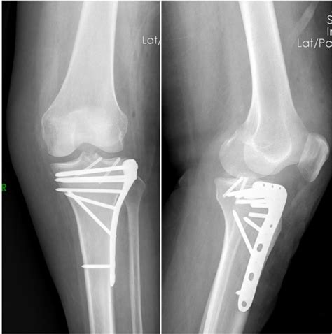 Diagnosis and Treatment of Schatzker Type II Tibial Plateau Fracture ...