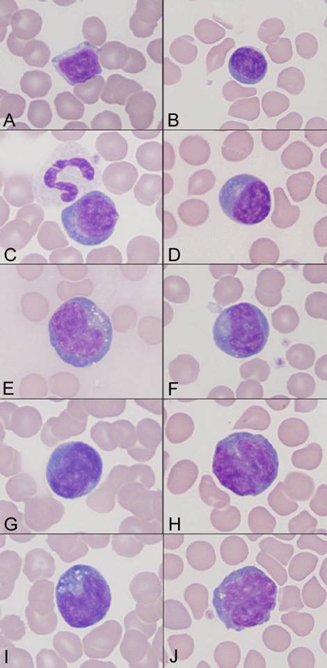 Lymphocytes Variation | Medical Laboratories