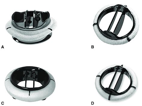 Prostheses used: A, On-X aortic valve (On-X Life Technologies/Artivion ...