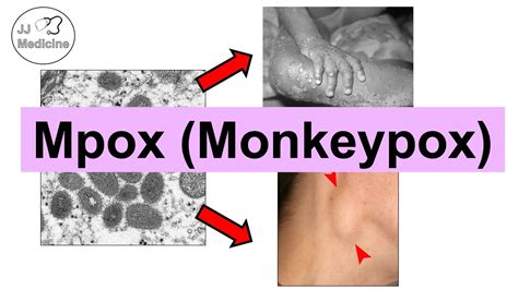 Mpox (Monkeypox) | Transmission, Pathophysiology, Signs & Symptoms ...