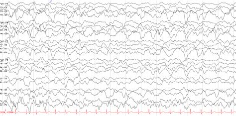 The Normal Asleep EEG