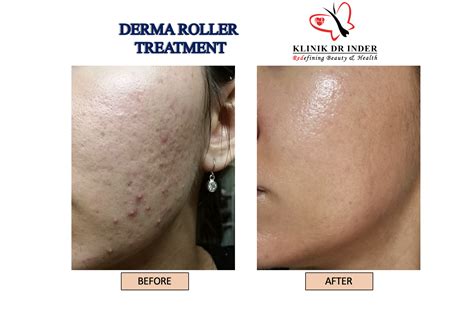 Derma Roller - Skin Treatment - Aesthetic Clinic Malaysia - Klinik Dr Inder