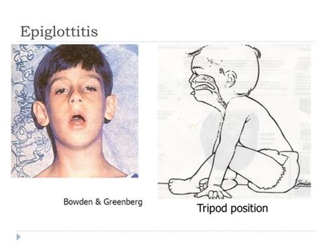 Epiglottitis Tripod