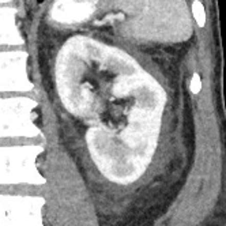 Perinephric stranding | Radiology Reference Article | Radiopaedia.org