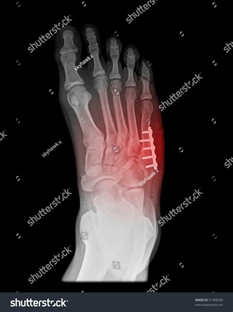 Foot Surgery Of A Jones Fracture On Black Background Stock Photo 51308296 : Shutterstock