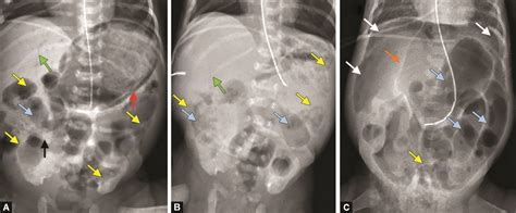 Necrotizing Enterocolitis Ultrasound