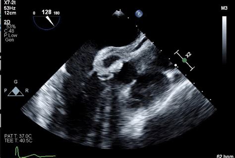 Transesophageal echocardiogram demonstrating aortic root abscess ...