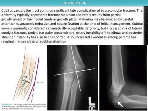 Supracondylar osteotomy for treatment of cubitus varus