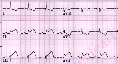 Acute Coronary Syndromes Definition and Review | LearntheHeart.com