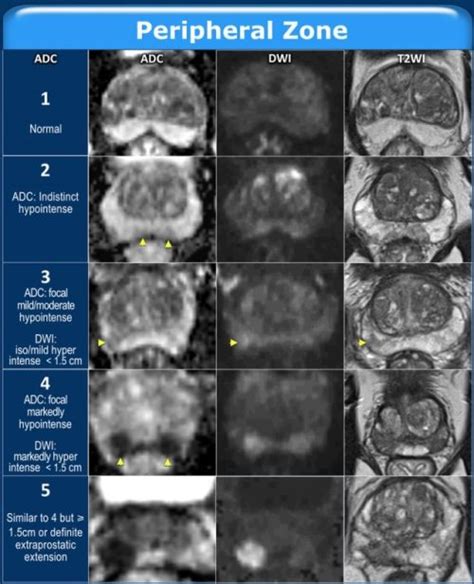 PI-RADS (Prostate imaging Reporting and Data System)