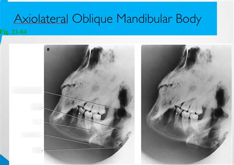 Axio Lateral Oblique Mandibular Body X ray anatomy Diagram | Quizlet