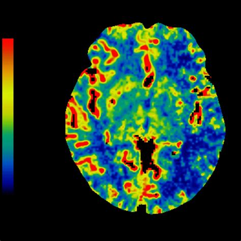 CT Perfusion 4D Neuro | GE Healthcare (United States)