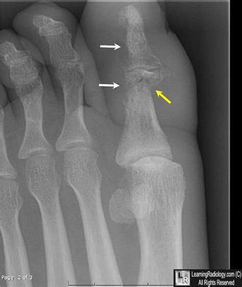 Osteomyelitis Pictures