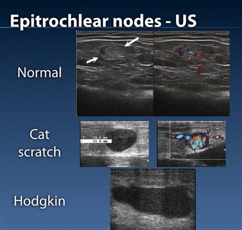 Epitrochlear Nodes