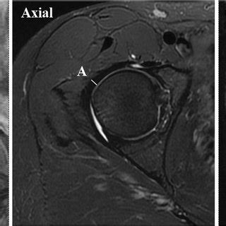 Hip joint capsule measurement technique. Coronal and axial ...