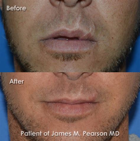 Lip Reconstructive Surgery - Before and After Photos - Dr. James Pearson Facial Plastic Surgery