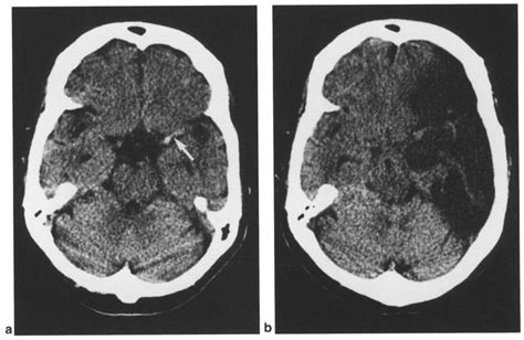 Hyperdense MCA Sign Radiology Blog Post, 40% OFF