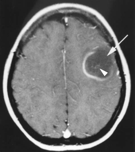 The MRI Appearance of Tumefactive Demyelinating Lesions | AJR