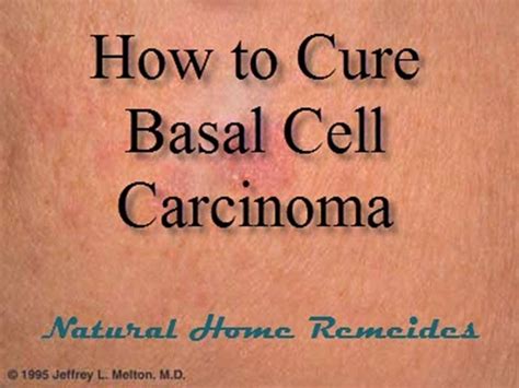 How to Cure Basal Cell Carcinoma - YouTube