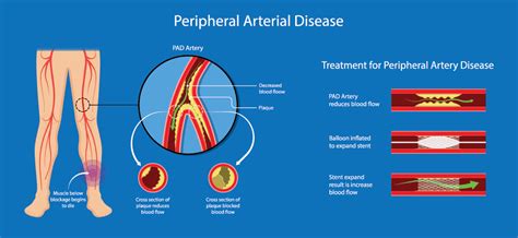 Peripheral Artery Disease: The Basics - El Paso, TX: Imaging & Interventional Specialists