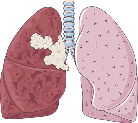 Pictures of Lungs After Quit Smoking & How We Can Help