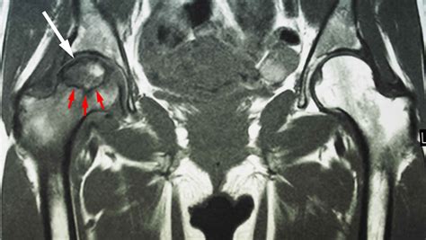 Osteonecrosis hip causes, stages, symptoms, diagnosis, treatment ...